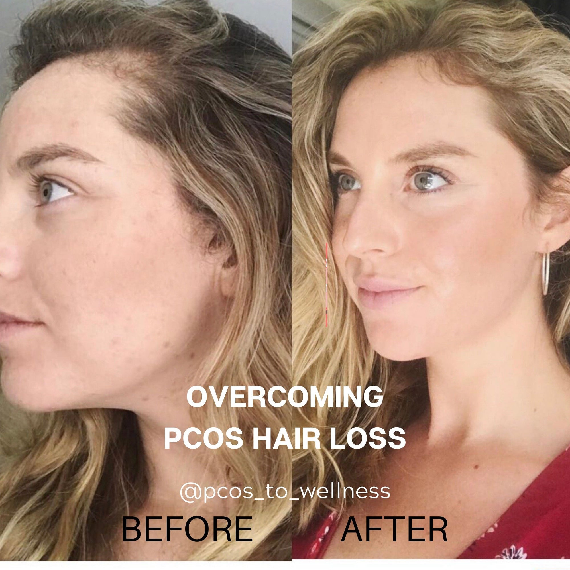 6 tips to help treat PCOS hair loss