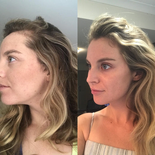 Curing My PCOS Hair Loss
